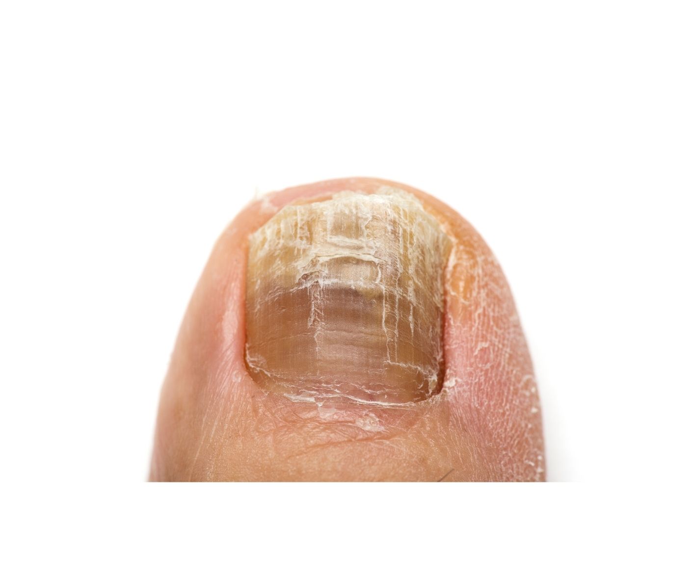 is-it-normal-for-your-whole-toe-to-hurt-after-getting-nail-removed